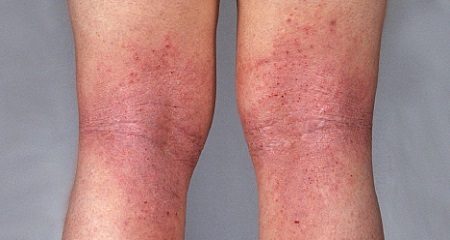 Атопический дерматит на ногах