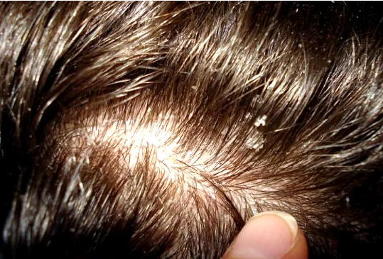 псориаз волосистой части головы
