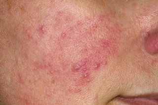 Picture of pink and red bumps with some bumps filled with a yellowish liquid