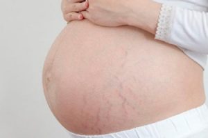 Растяжки на животе у беременной