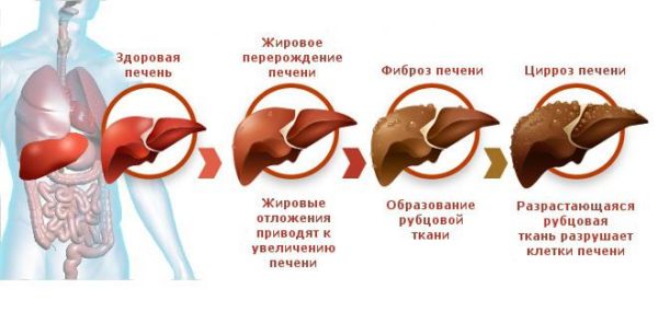 Стадии Цироза