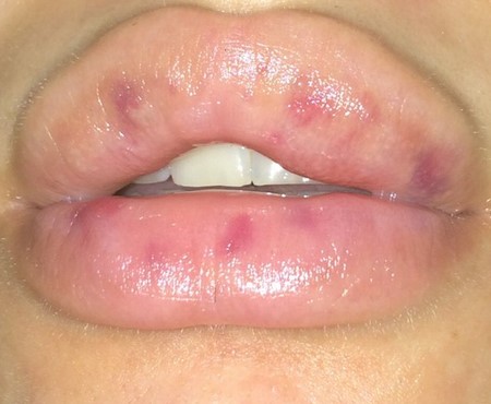 Возможные осложнения после проведения инъекций для объема губ