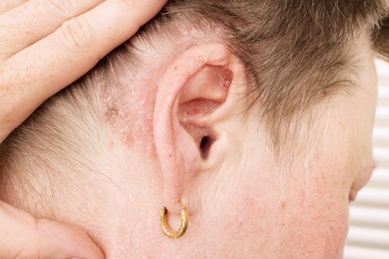 Что нужно делать, если у вас шелушатся уши – рассказывают специалисты