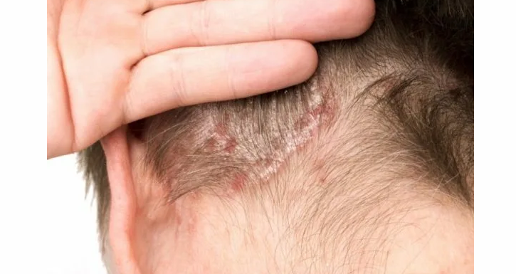 Себорейный дерматит — на затылке, под волосами появились красные пятна и шелушатся