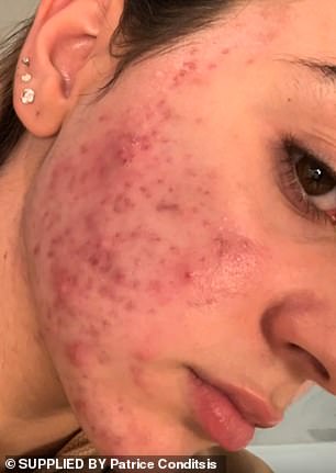 The 18-year-old from Sydney, Australia, had only wanted to get rid of the black hairs around her side burns, cheeks and upper lip when acne began to form