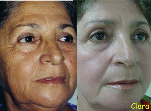 Before and after:  A woman pictured before her chemical peel, left, and and one month after, right