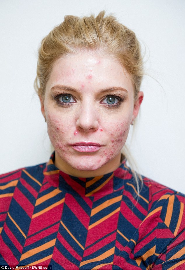 Georgie Aves, 26, from London, had C02 laser treatment, which has left her with acne and scaring and now she is afraid to be seen in public after the reaction to a laser 