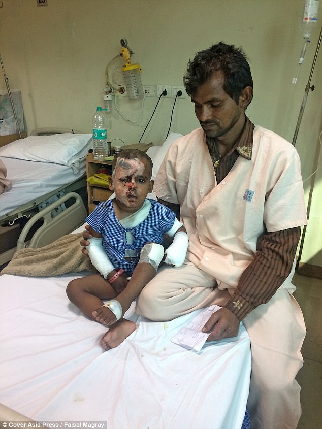 Recovery: Aditya was taken to the burns unit of Delhi¿s Safdarjung Hospital and was transferred to a private hospital in Gurugram. He¿d suffered nearly 20 per cent burns to his face, one shoulder and both his hands. He faces further surgery to prevent him losing an eye