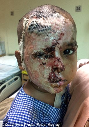 Horrific burns: Aditya Raj, two, in India, had acid thrown in his face and was dumped in a bin allegedly by his mother