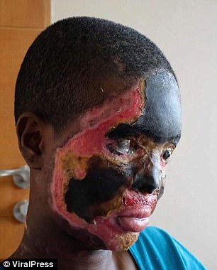 The horrendous acid attack has left her with injuries so severe that her mouth has been melted shut