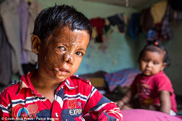 Three-year-old Aditya Raj (left) pictured after his surgery at his residence in Gurugram area of Haryana, India