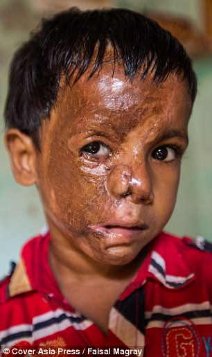 This boy was burned with acid because she rejected a man