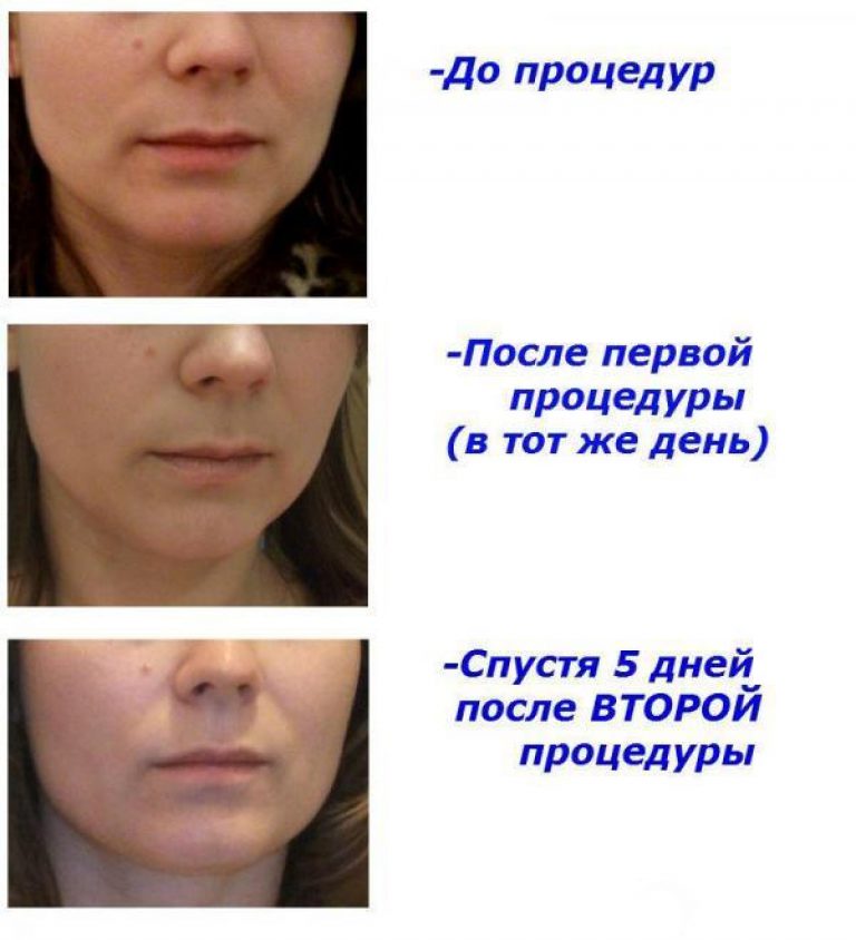 Рф процедура отзывы. RF лифтинг до и после. RF лифтинг лица. RF лифтинг лица фото до и после. RF лифтинг лица эффект.
