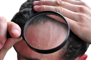 Особенности лечения шелушения кожи головы