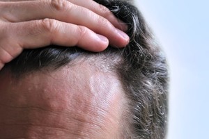 Как лечить кожу головы