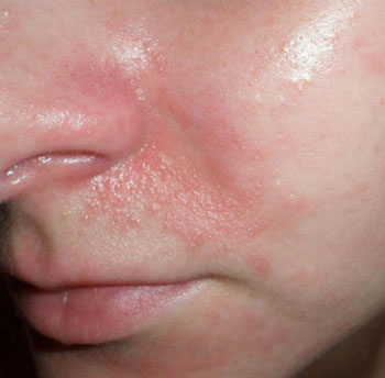 Чем вызвано покраснение кожи вокруг носа