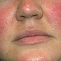 Причины красного носа и кожи вокруг него