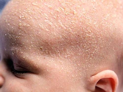 Шелушение кожи головы у младенца