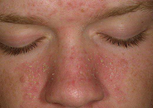 мазь от себорейного дерматита на лице