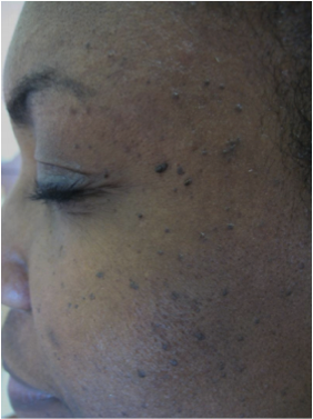 Skin lesions on the face 