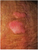 Papilloma