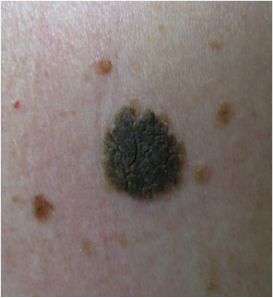 Seborrheic Keratosis