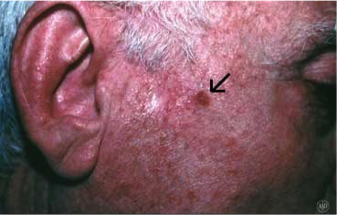 Squamous cell carcinoma